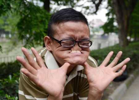 (miniature) Le record du monde du visage le plus tordu détenu depuis 10 ans par un chinois